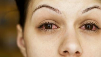 Co to jest zapalenie spojówek (grypa oka) i jakie są objawy? Jak przenosi się zapalenie spojówek?