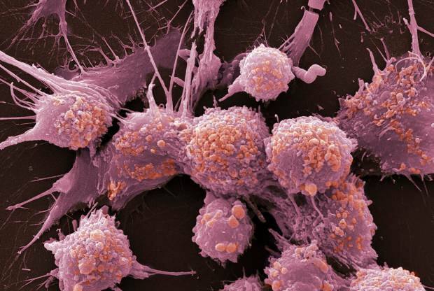 Co to jest rak i jakie są jego objawy? Ile jest rodzajów raka? Jak się zapobiega rakowi?
